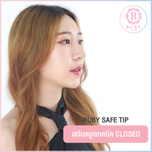 เสริมจมูก Rhinoplasty Closed